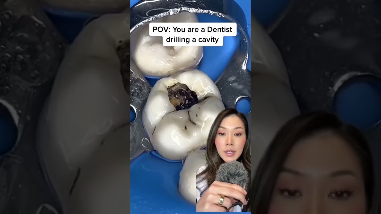 An up close look of drilling a large cavity. 