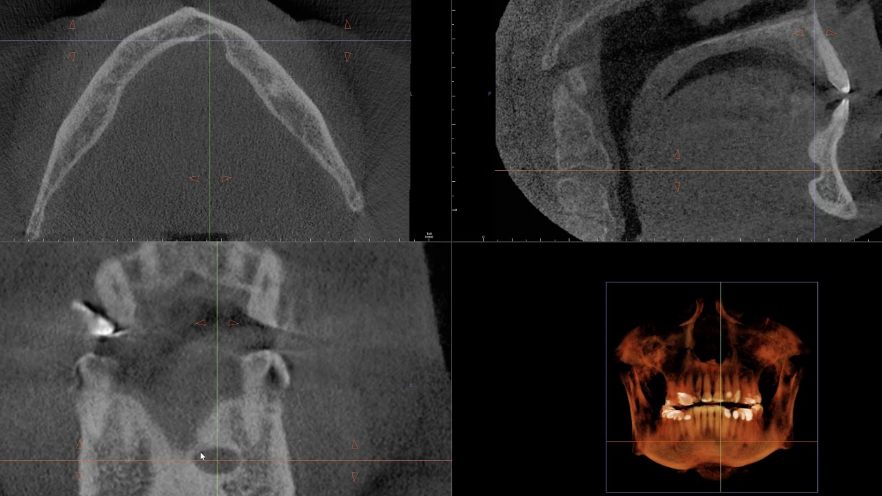 Stafne defect rare anterior variant