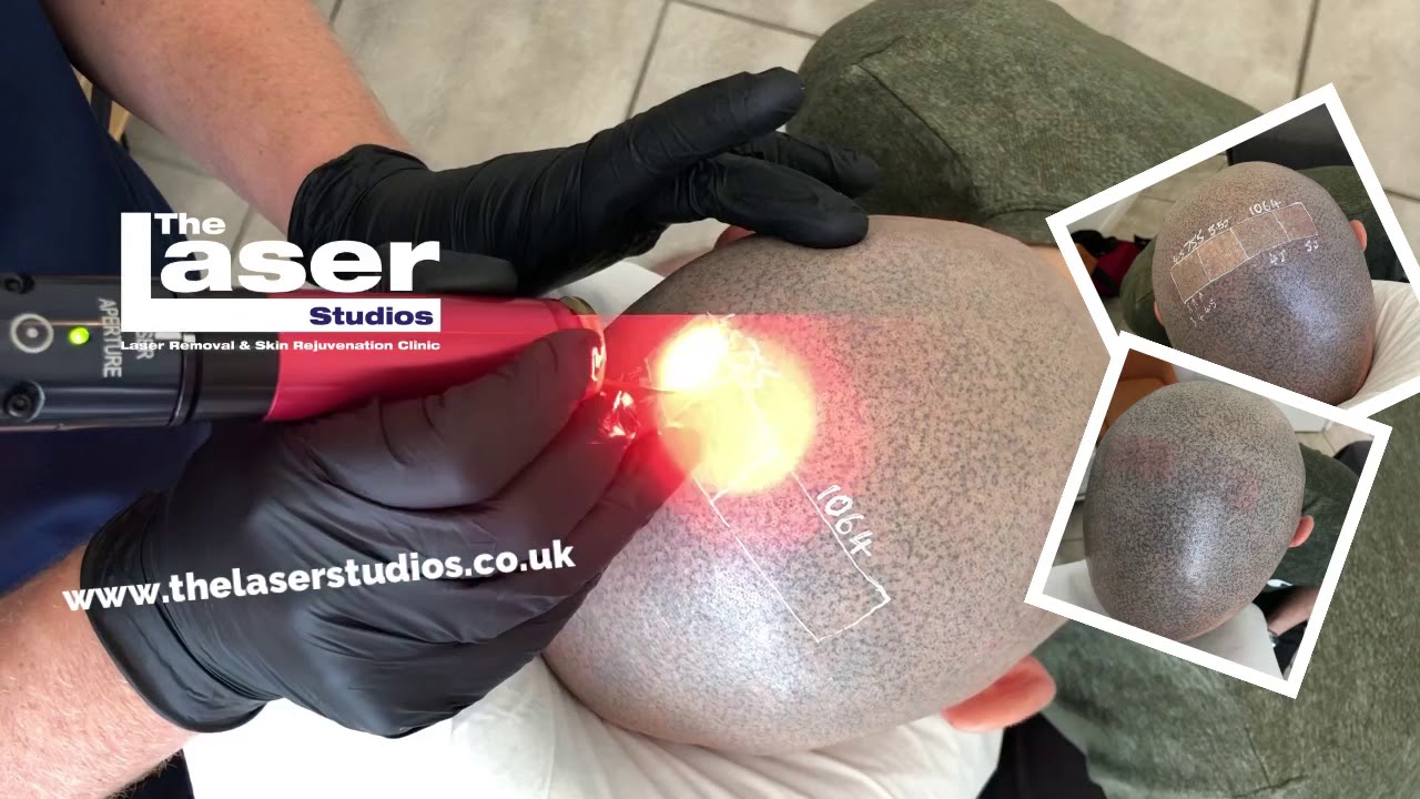 Laser - the SAFEST method to Remove Scalp Micropigmentation. SMP Laser Removal Clinic near London UK