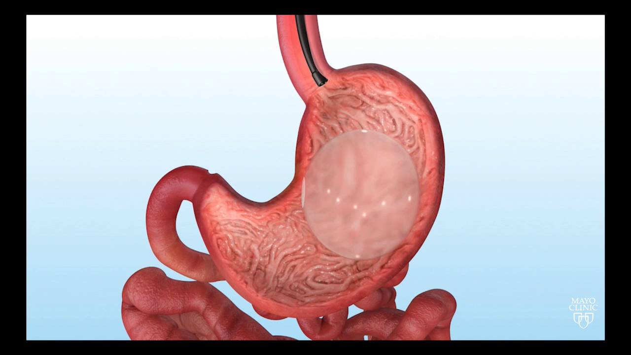Endoscopic Gastric Balloon for Bariatric Weight Loss