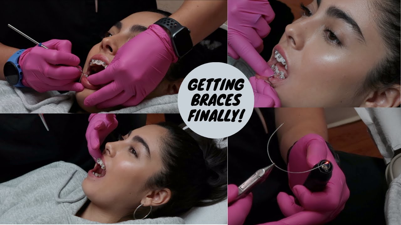 GETTING MY WIRES PUT ON!! (BRACES PT. 3)