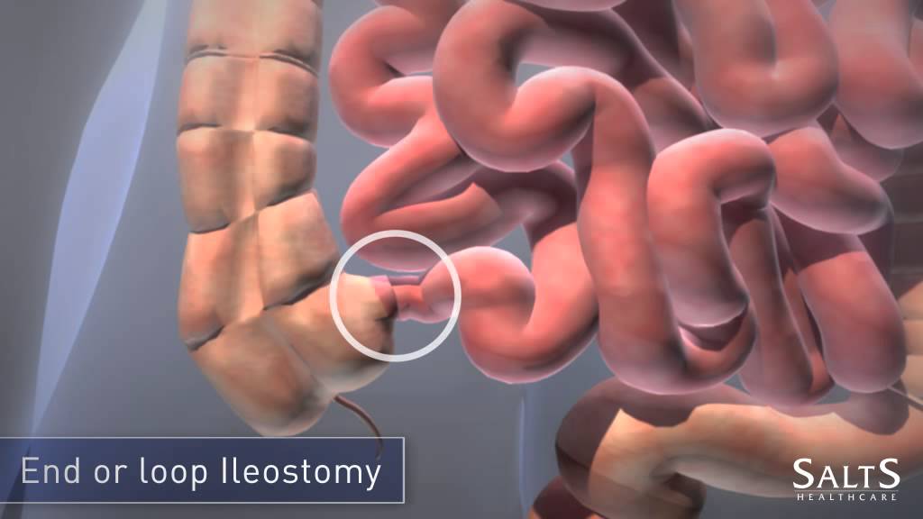 What is an Ileostomy?