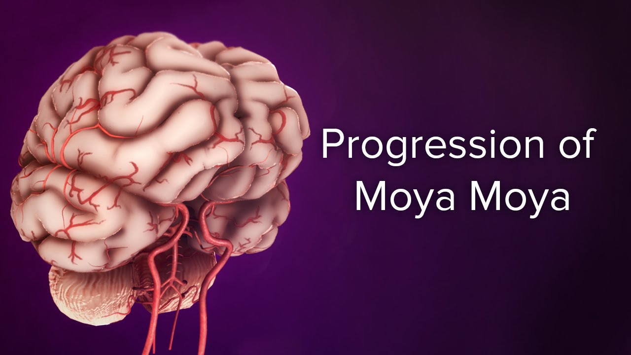 Medical Animation: Progression of Moyamoya | Cincinnati Children's Cerebrovascular Center
