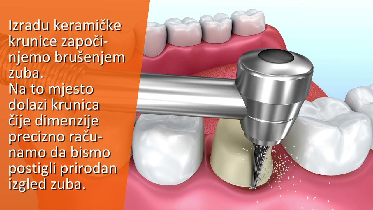 Zubne krunice | Smile makeover | Dentech Split