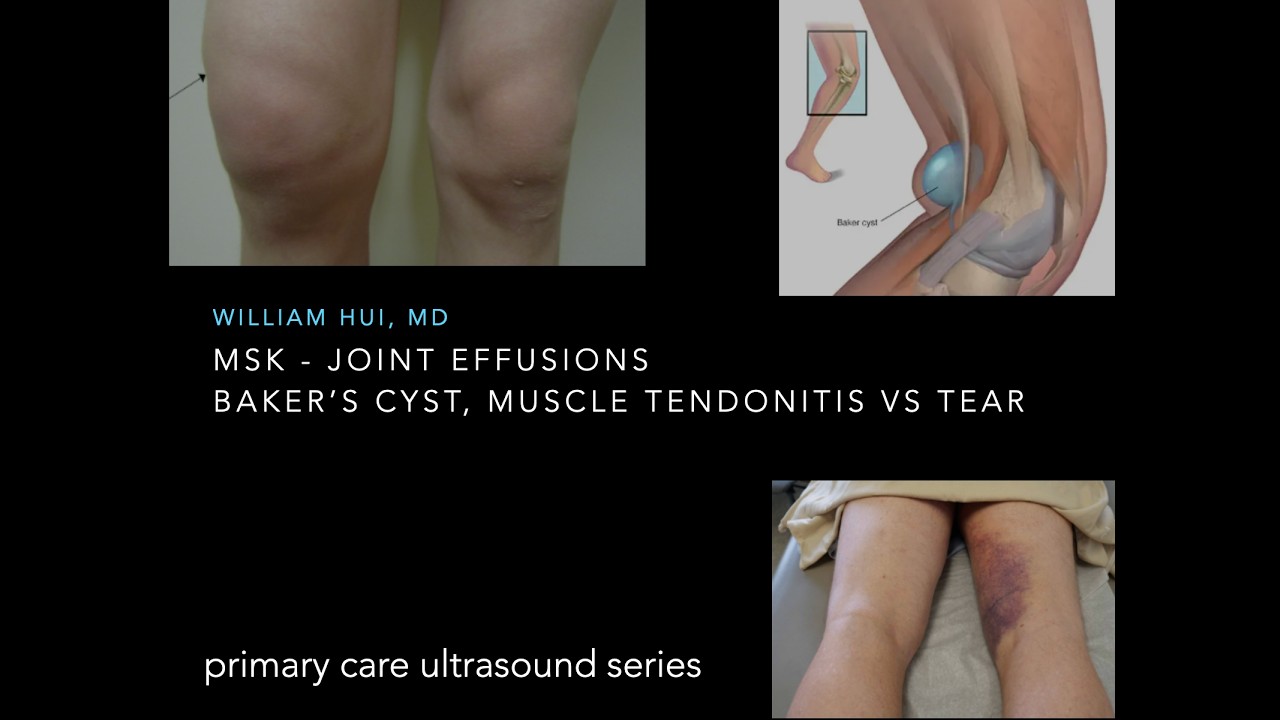 Primary Care POCUS - 3 - Joint effusions, Baker's cyst, Achilles tendonitis/tear