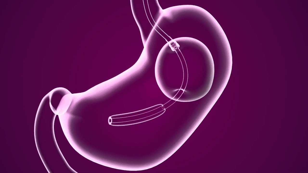 About the ReShape Gastric Balloon Non-Surgical  Procedure