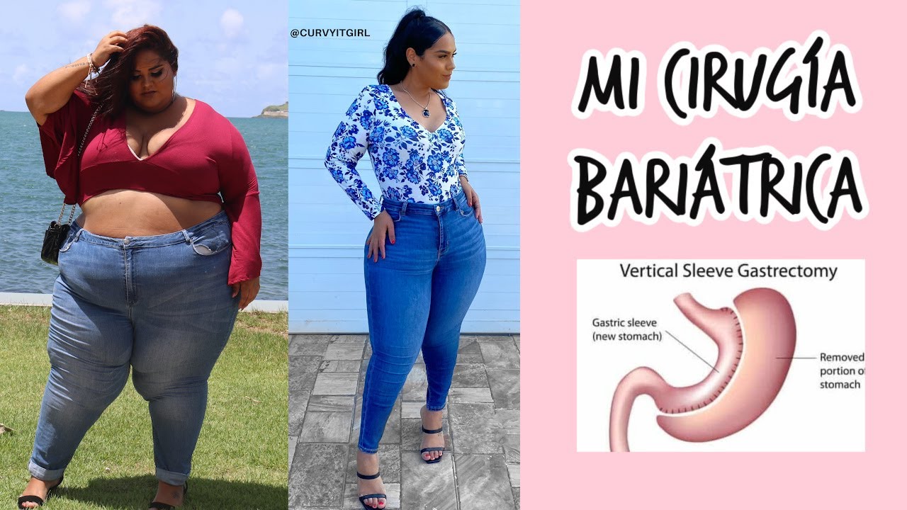 Mi EXPERIENCIA con la cirugía bariátrica (PERDIDA DE PESO -250 LBS) embarazo al mes de operarme.