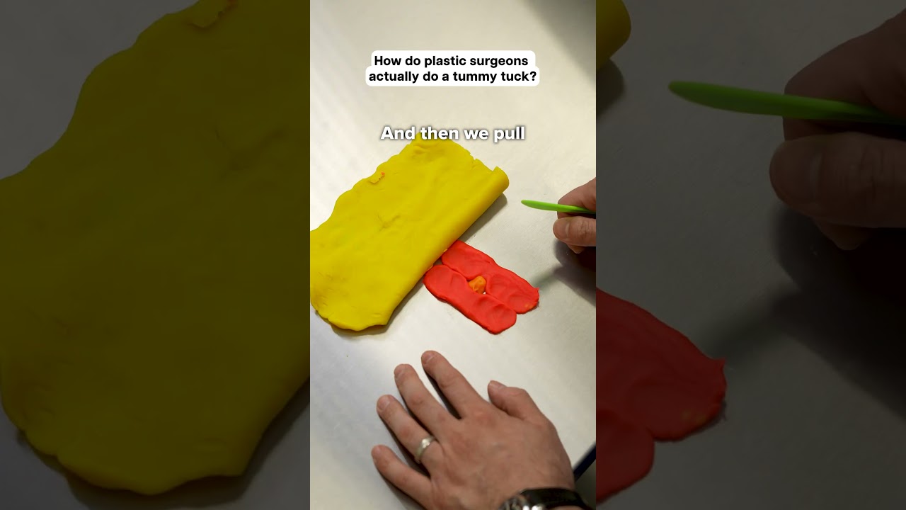 Как пластические хирурги проводят подтяжку живота?