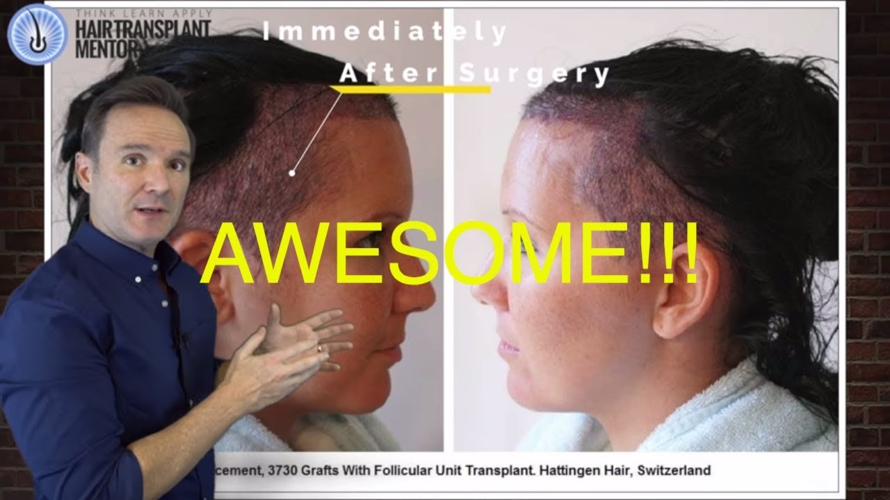 Клиника пересадки волос - Hattingen Hair for EXCELLENT FUT & FUE