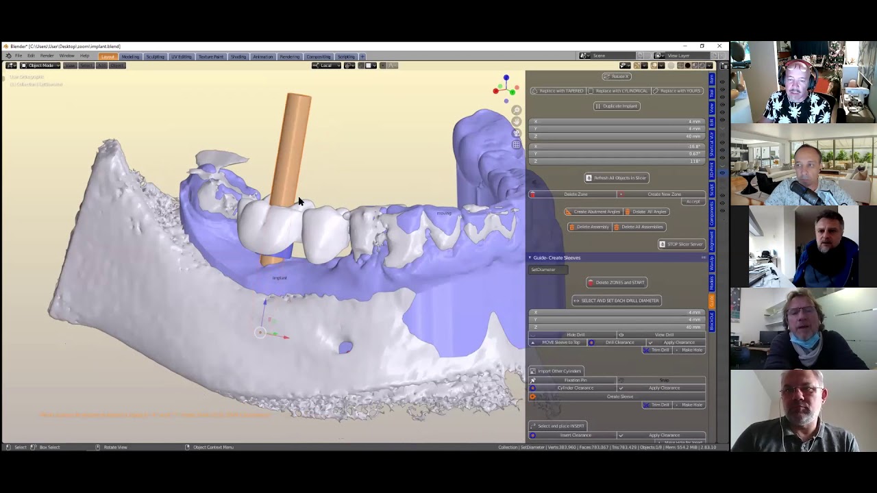 B4D Zoom Implant Crowns