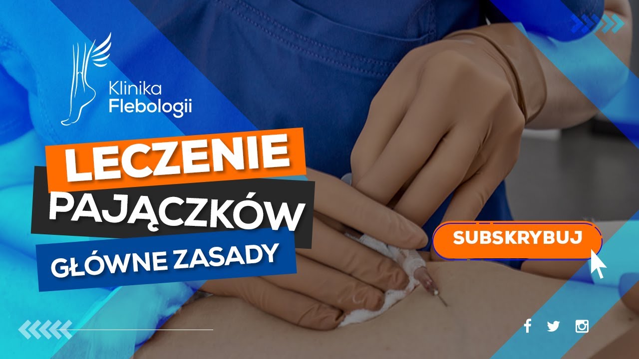 Leczenie pajączk&oacute;w - gł&oacute;wne zasady