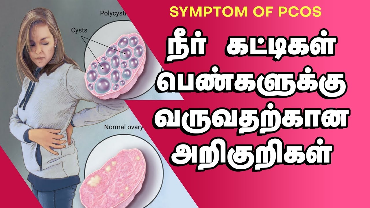 Dr G Buvaneswari | Fertility Specialist | PCOS In tamil | நீர்கட்டிகள் அறிகுறிகள் மற்றும் காரணங்கள்