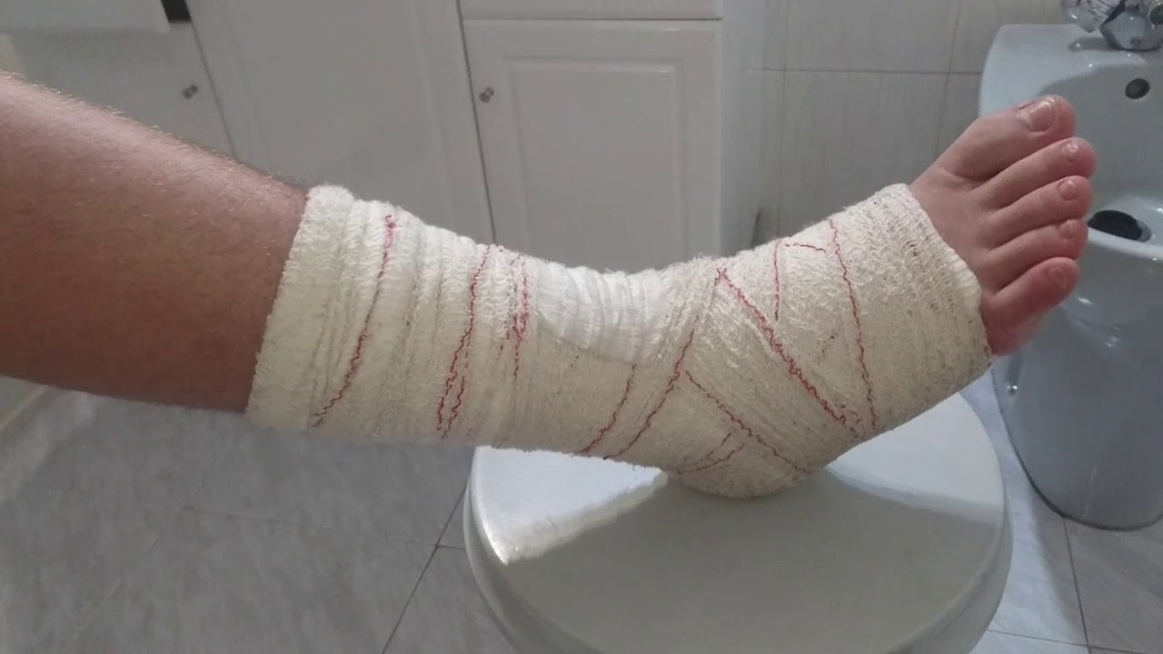 Truco Como ba&ntilde;arte o ducharte sin mojar el vendaje o la escayola yeso