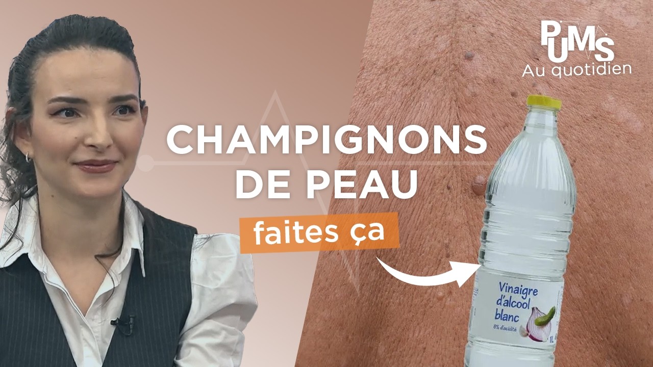Du VINAIGRE contre les CHAMPIGNONS de la peau : efficace ?