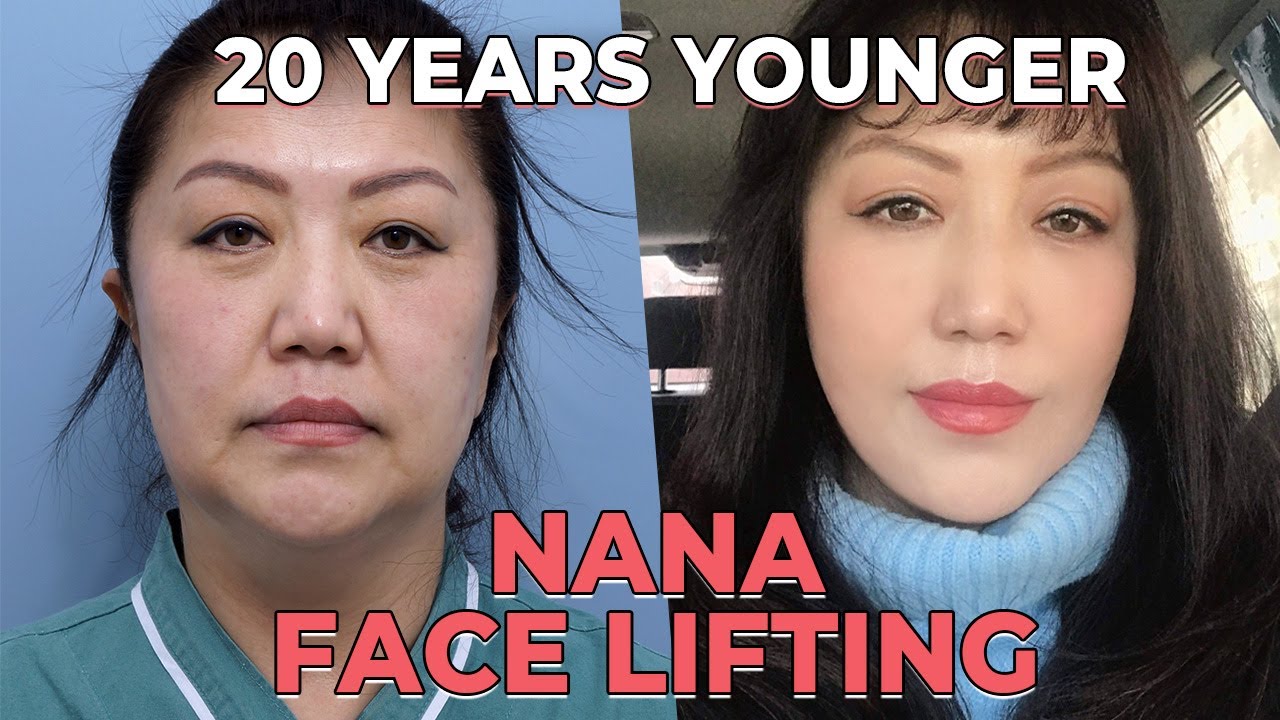 [SUB] Anti-Aging | Face Lift and Neck Lift Surgery | Before After, Recovery in Korea Plastic Surgery