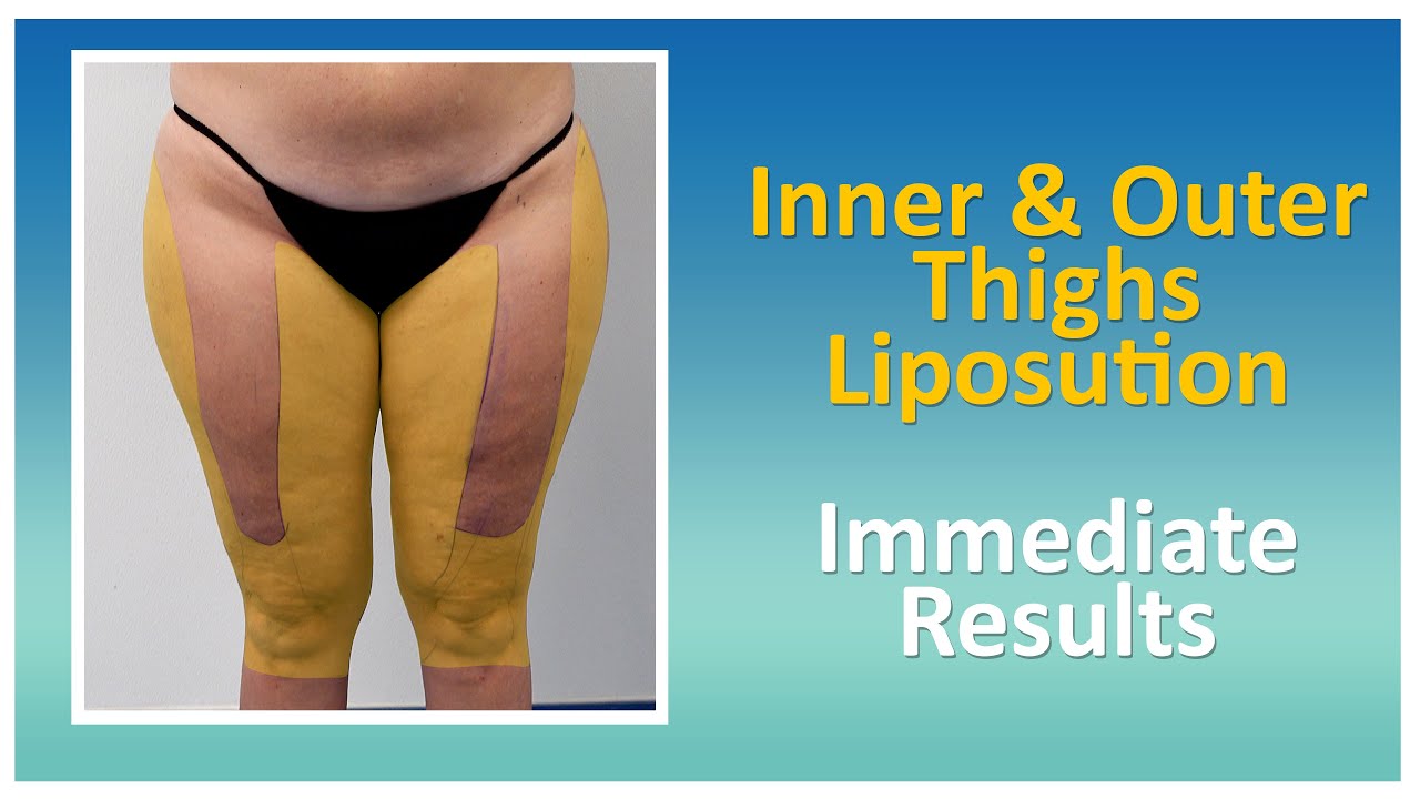 Thigh & Knee Liposuction Results | Lipo 360° Legs | Lipedema Surgery  | Expert Dr. Thomas Su