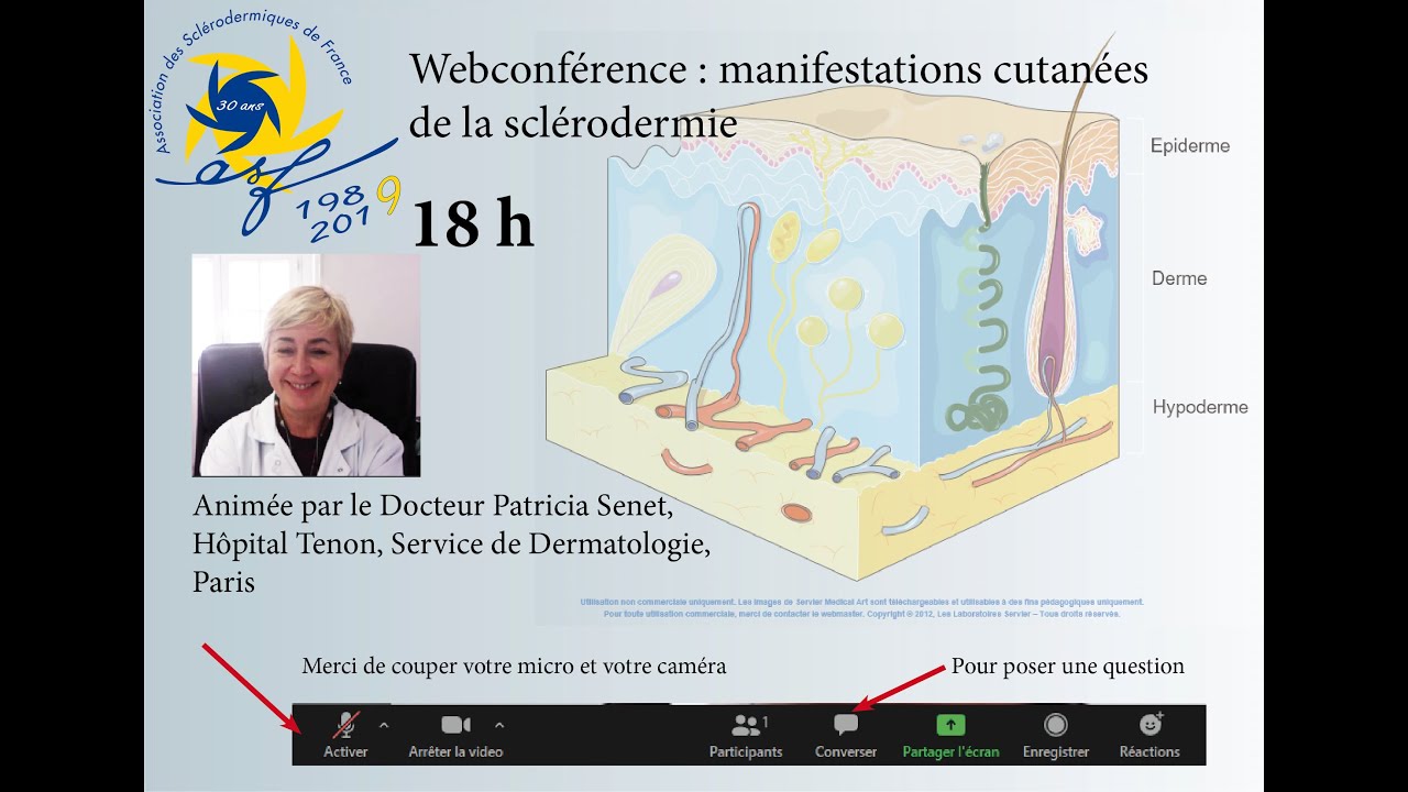 Webconférence Les atteintes cutanées de la sclérodermie