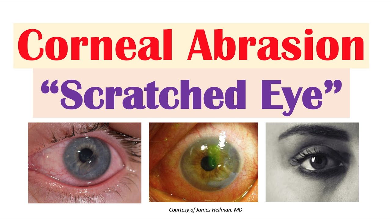 Corneal Abrasion (&ldquo;Scratched Eye&rdquo;) | Causes, Signs & Symptoms, Diagnosis, Treatment