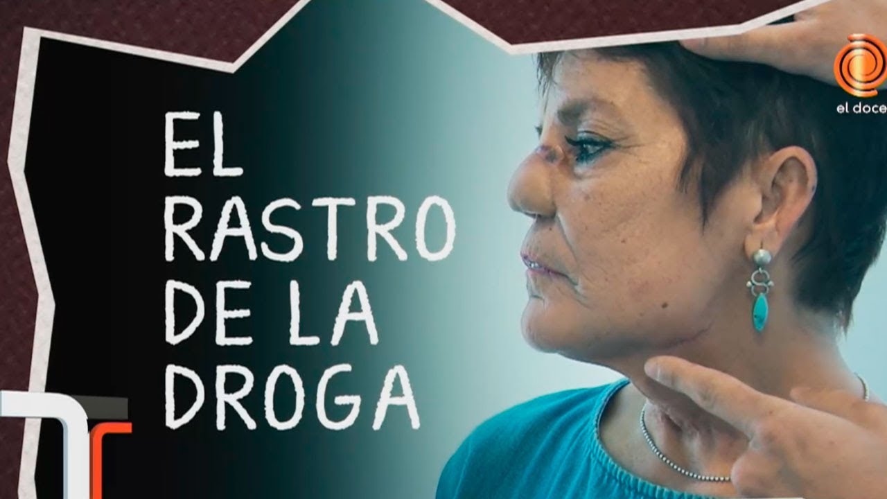 HISTORIAS DE HOY: Una mujer perdió su nariz por consumir droga