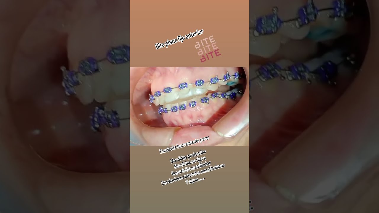Bite Plane Fijo, o Plano de mordida anterior fijo. Herramienta versátil en Ortodoncia!