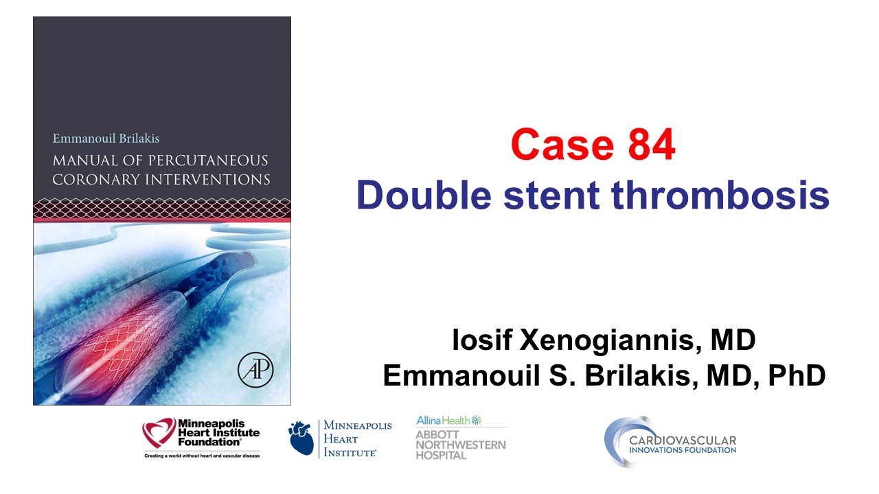 Case 84: PCI Manual - Double stent thrombosis