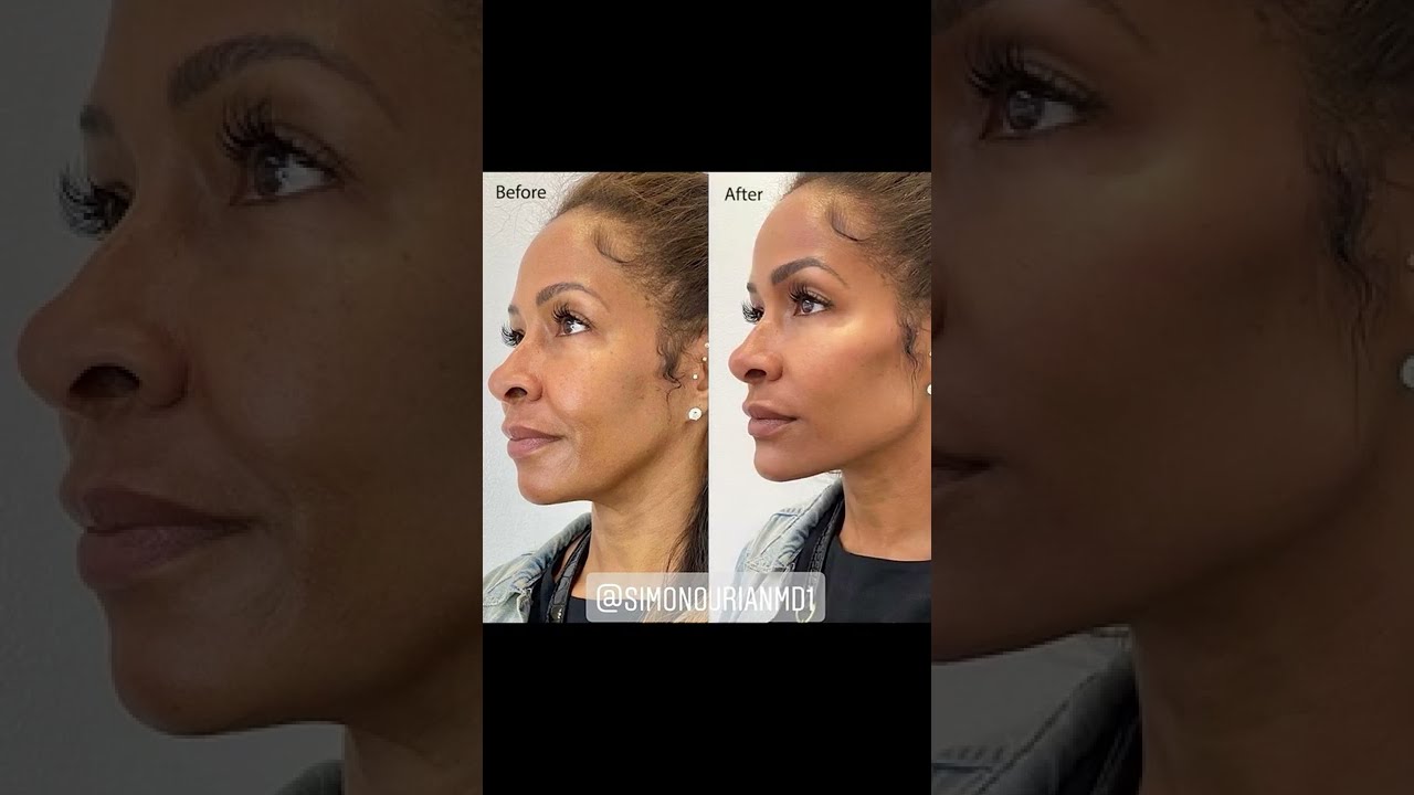 Instant, Non-Surgical Facial Contouring