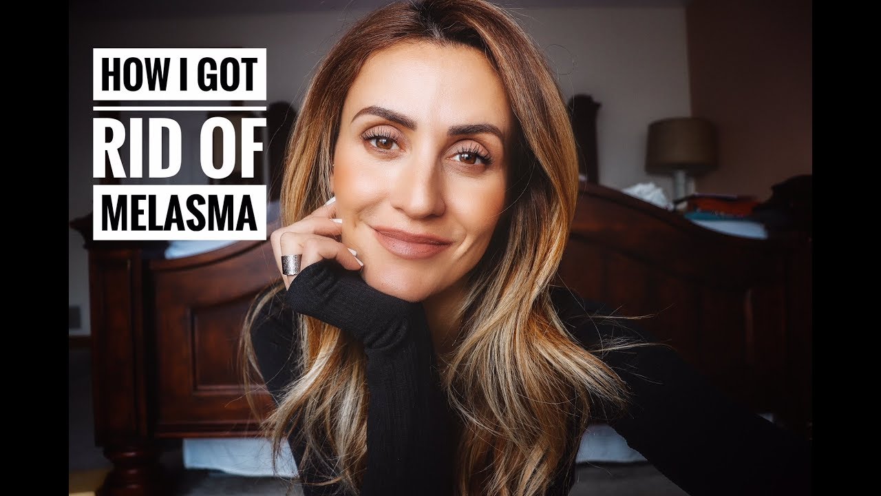 How I Got Rid Of Melasma on my Face | Beauty | Karina Style Diaries