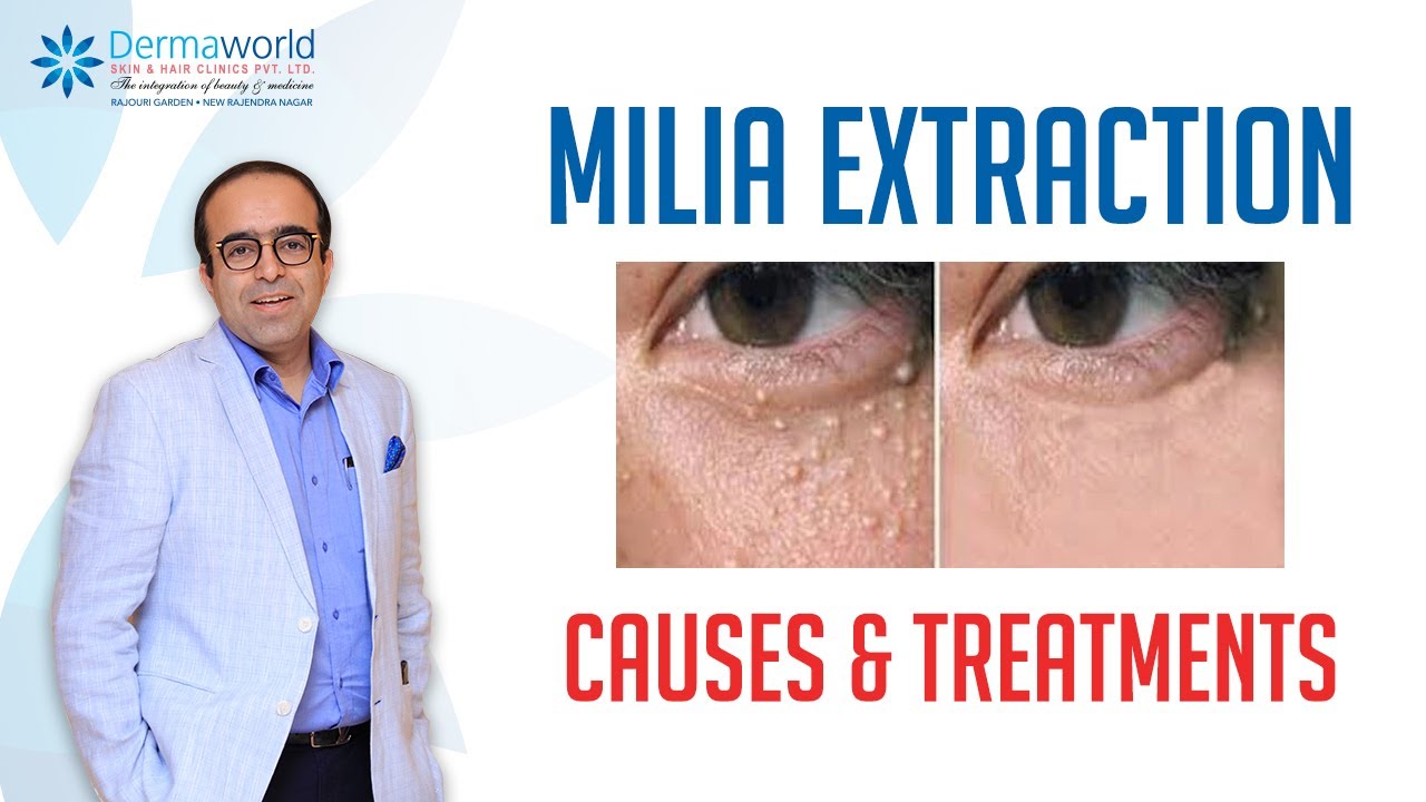 Milia Extraction Causes and Treatment | Milia under the eyes | Dr Rohit Batra