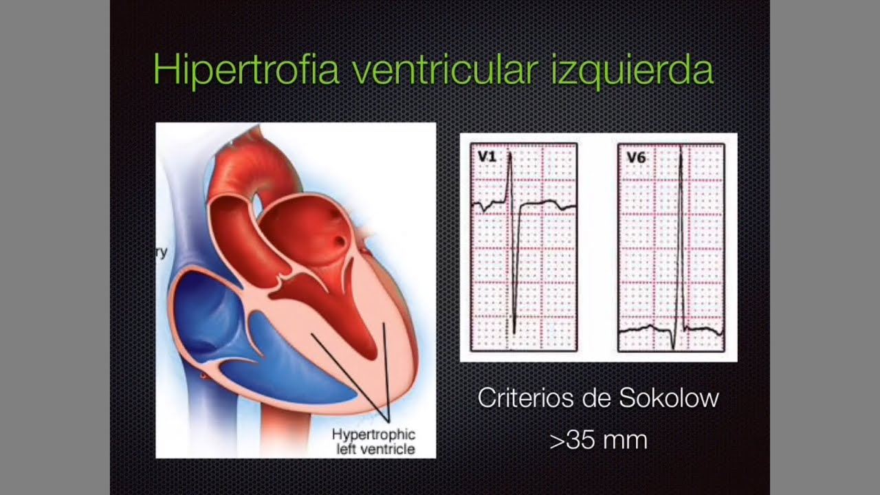 EKG patológico 3: Hipertrofia, infarto y más