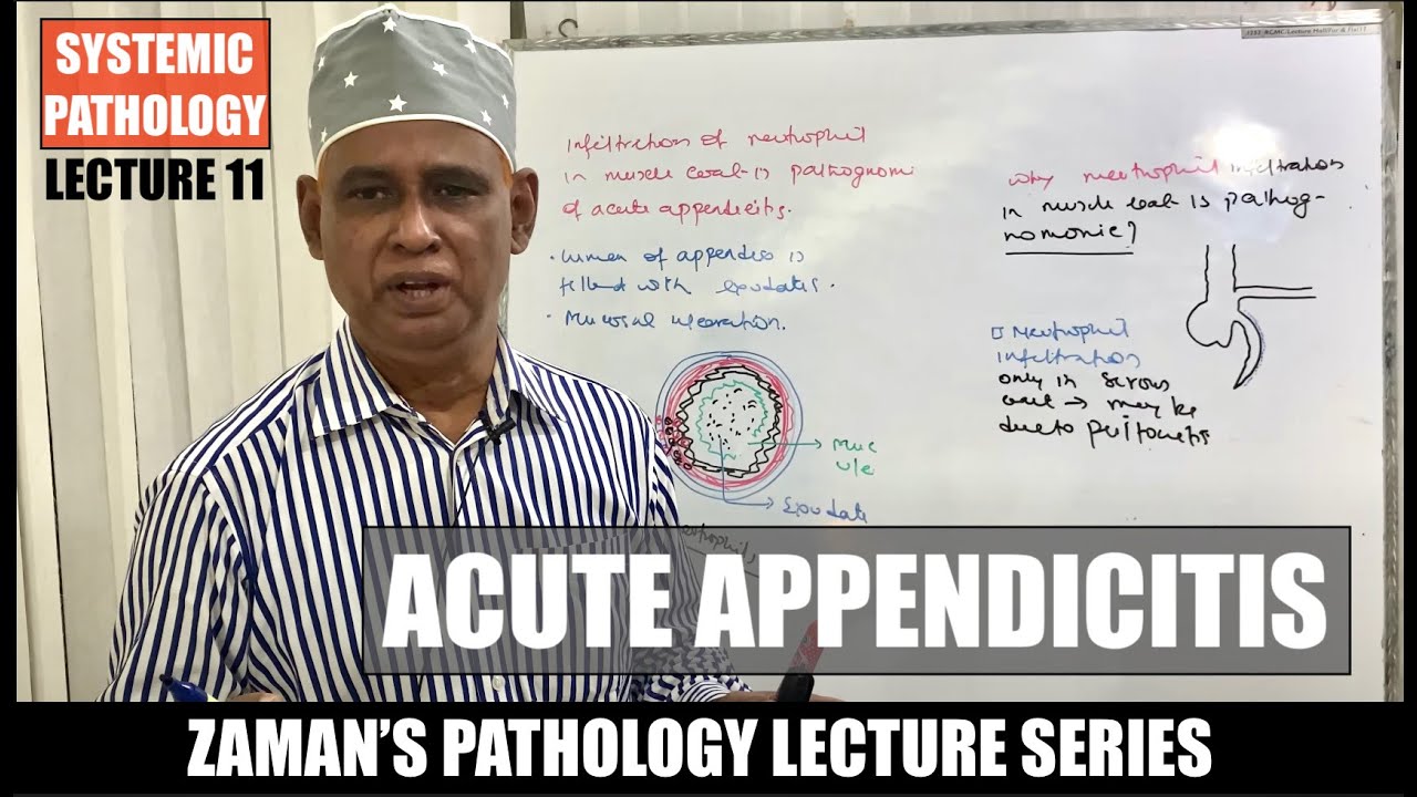 Systemic Pathology: Lecture 11 | Acute Appendicitis