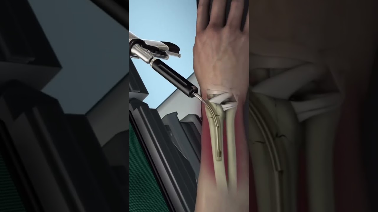 La reparaci&oacute;n de fracturas &oacute;seas busca devolver al hueso su alineaci&oacute;n y funci&oacute;n normal.