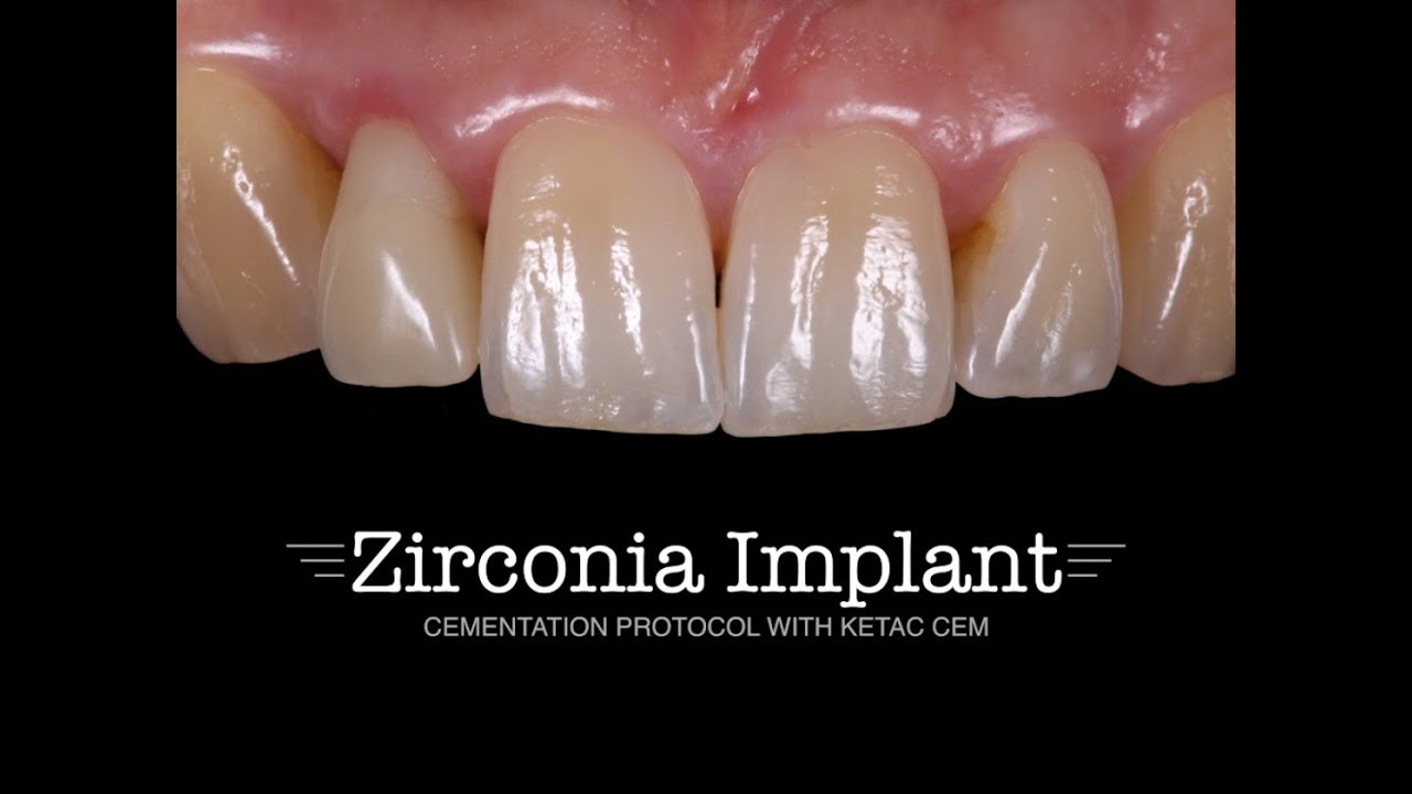 Zirconia Implant &mdash; Cementation protocol with Ketac CEM | Dr. med. dent. Michael Gahlert