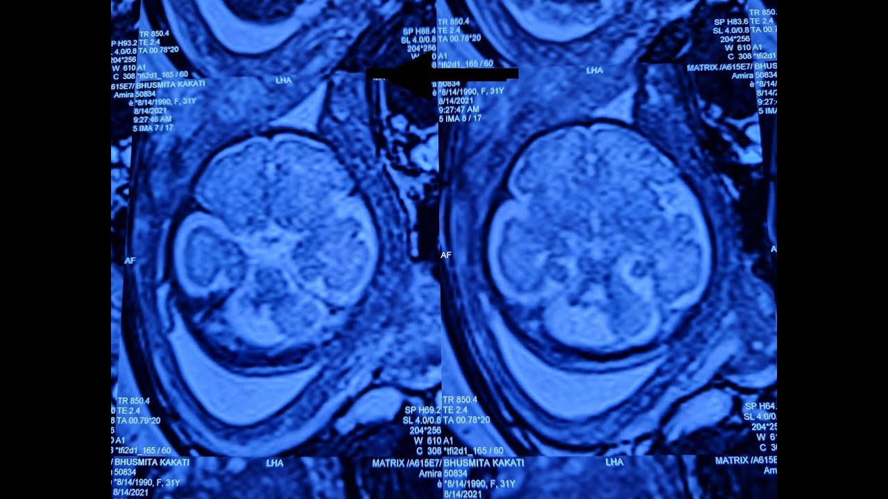 Cerebellar Hemorrhage antenatally by Dr S Chowhan, Fetal Medicine Consultant