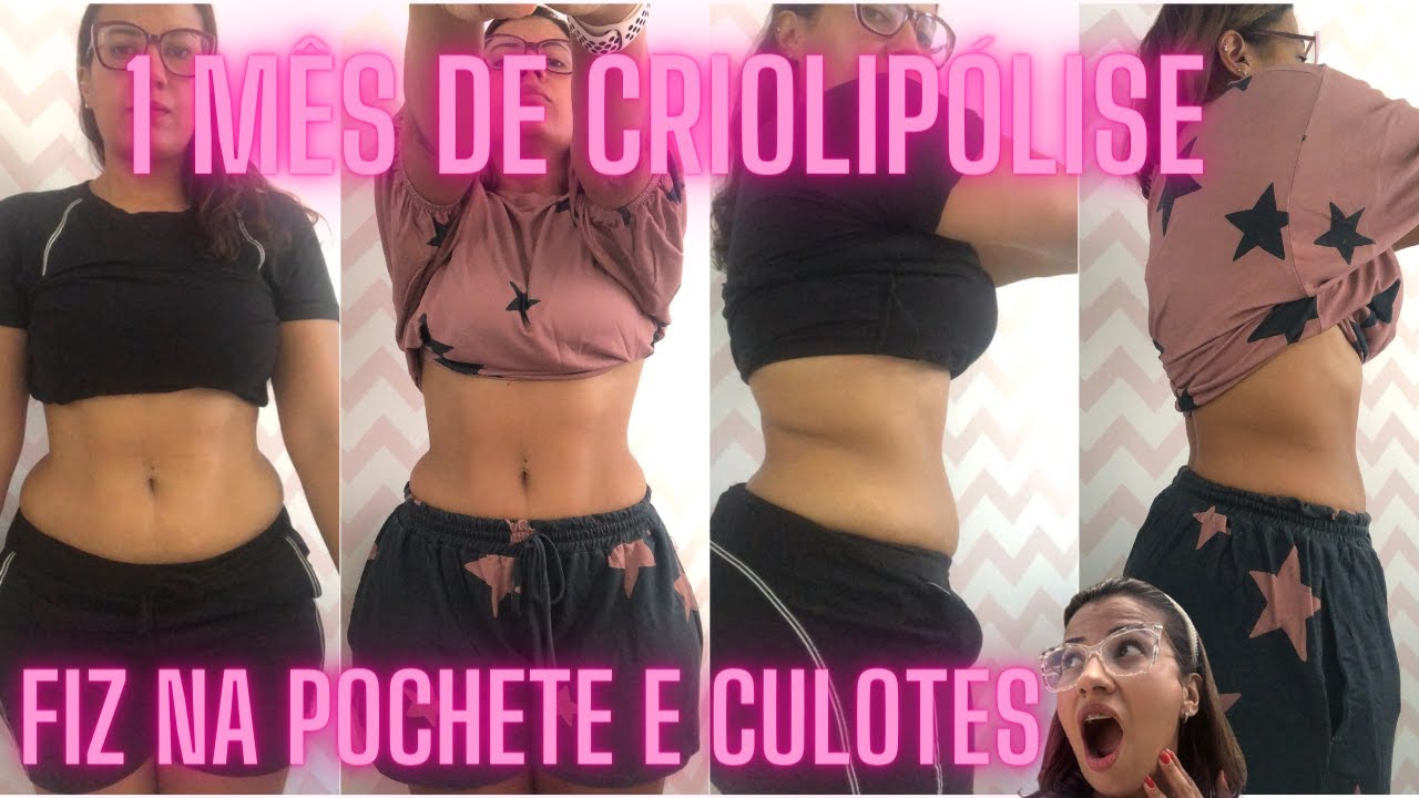 FIZ CRIOLIPÓLISE NA BARRIGA E MOSTREI TODA A EVOLUÇÃO ATÉ O RESULTADO FINAL