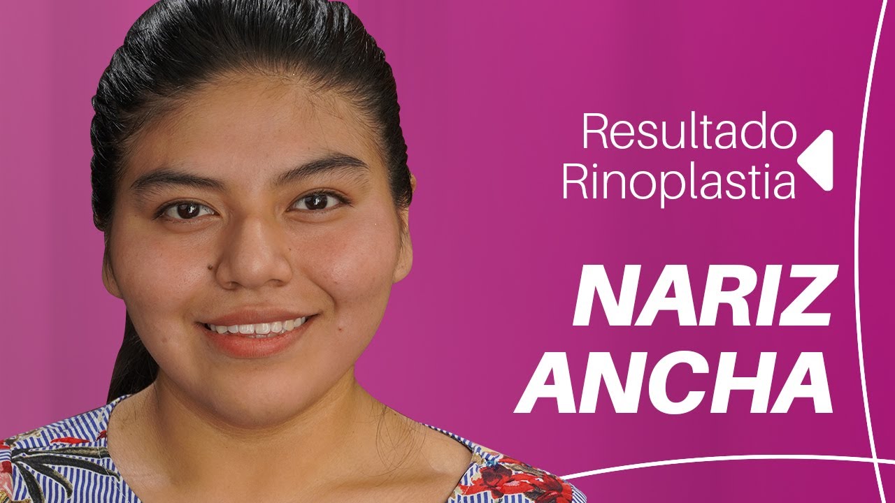 RINOPLASTIA EN NARIZ ANCHA