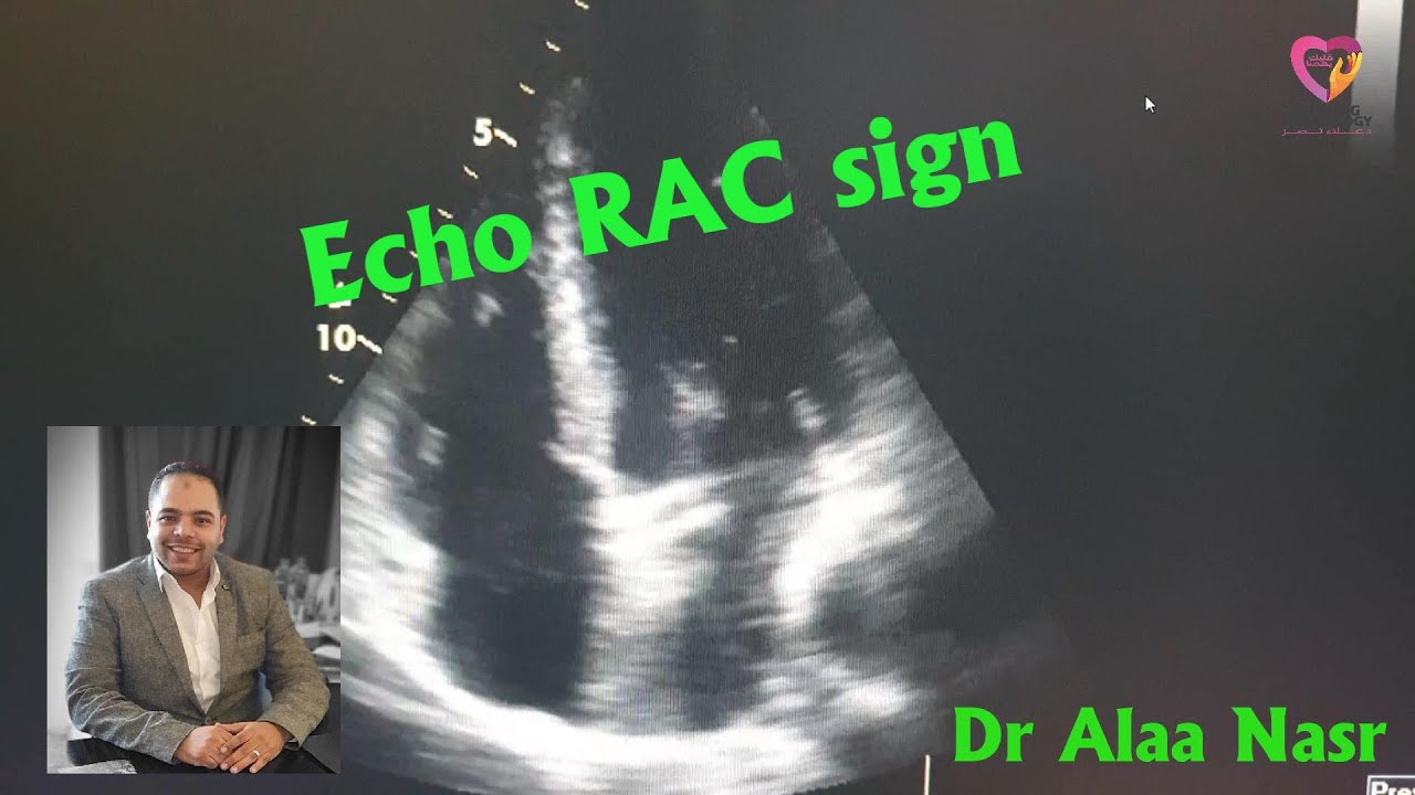 RAC Echocardiographic sign, Dr Alaa Nasr, 2022