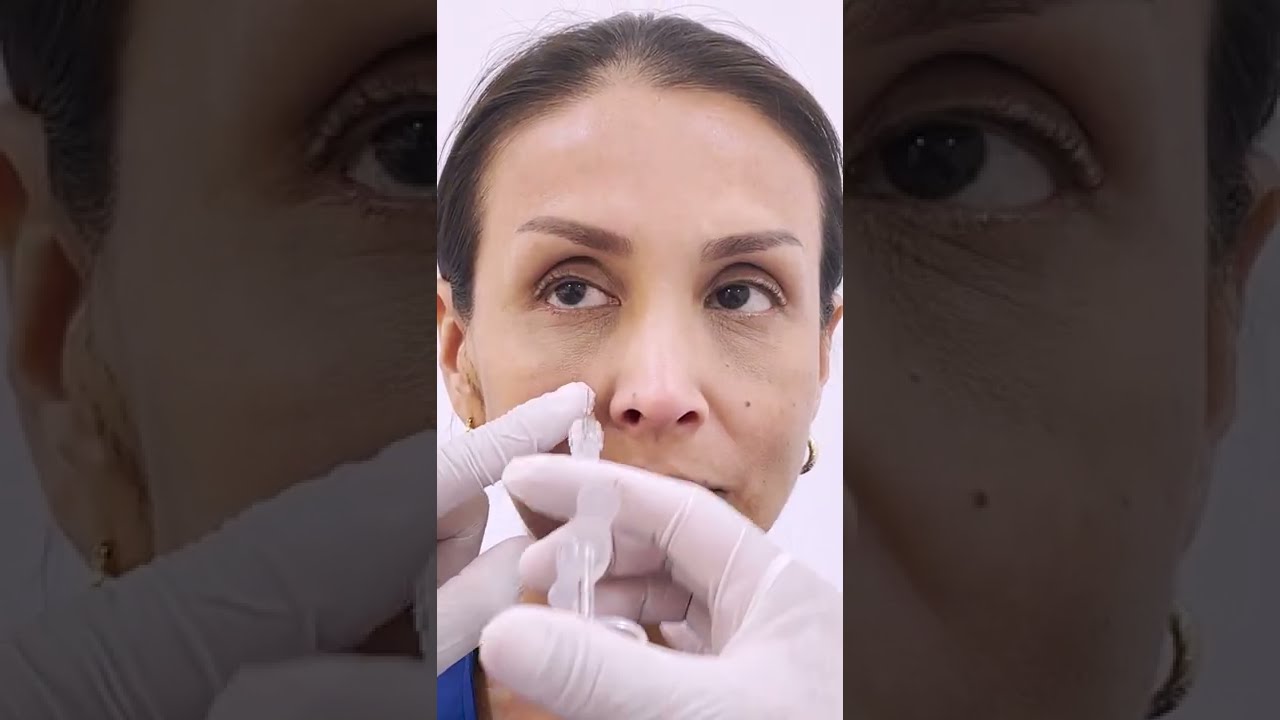 AUMENTO DE PÓMULOS CON ÁCIDO HIALURÓNICO - DR. FRANK ZEGARRA