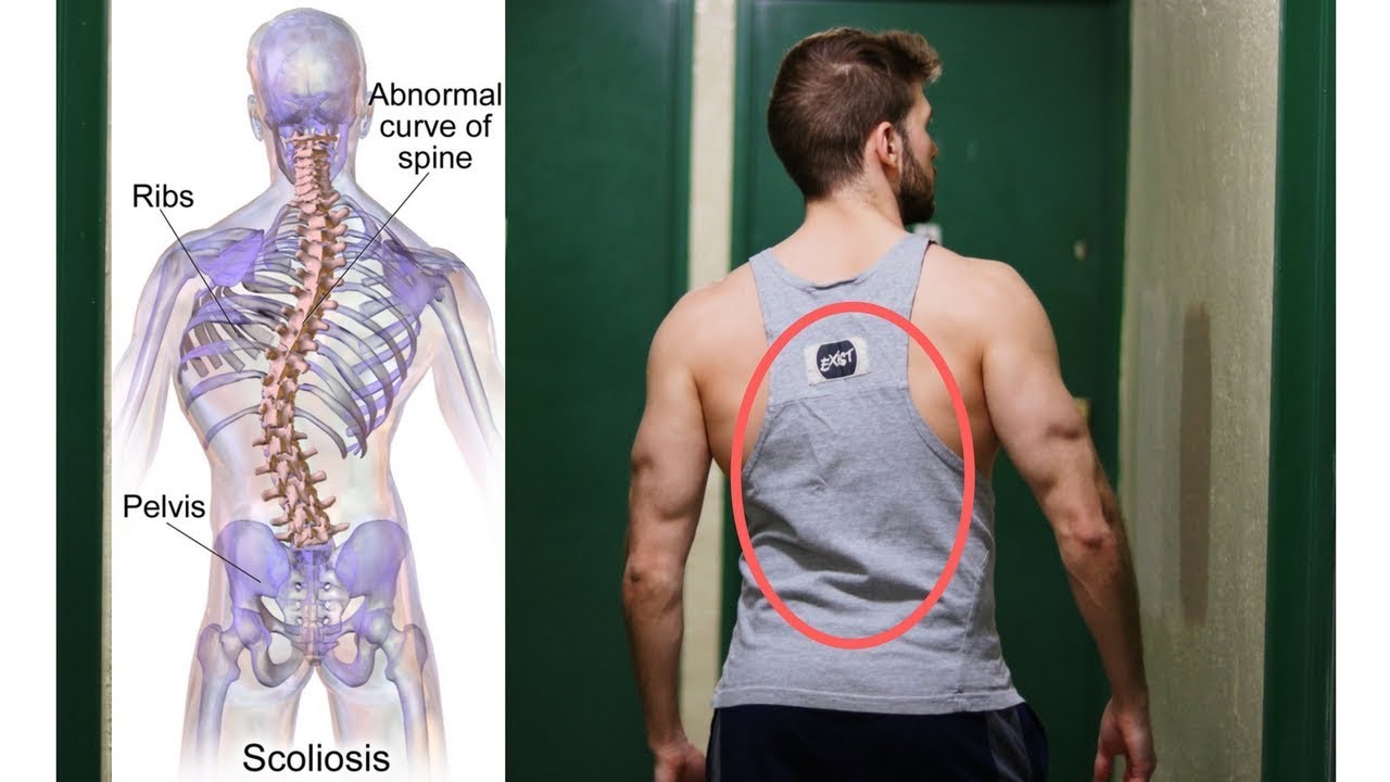 The Truth About Scoliosis and Fitness