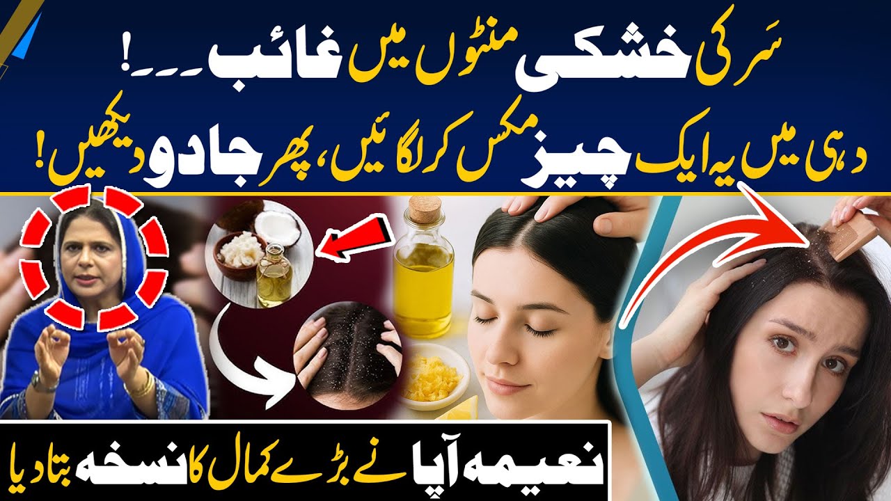 Home Remedies for Dandruff | Natural Dandruff Removal Hack | Morning With Fiza