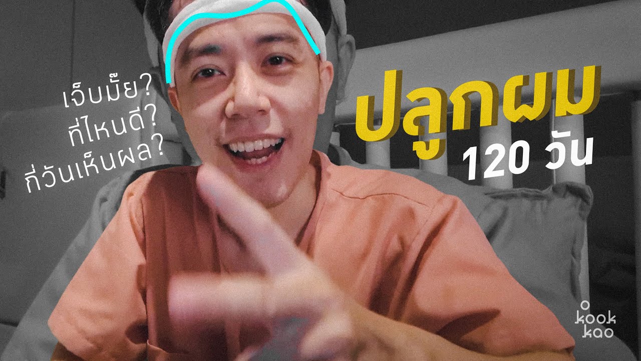 รีวิวปลูกผม 4 เดือน | ละเอียดยิบ จบในคลิปเดียว - o kookkao