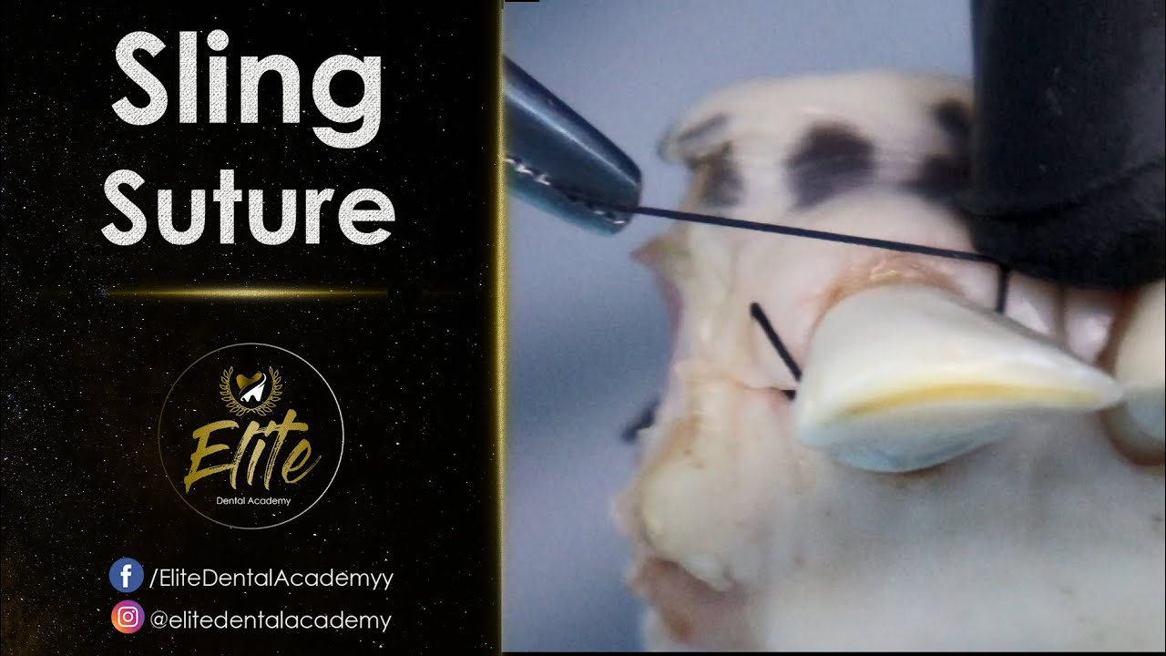 Sling Suture