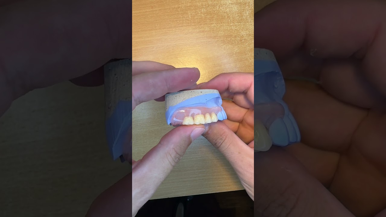 flexible partial denture 