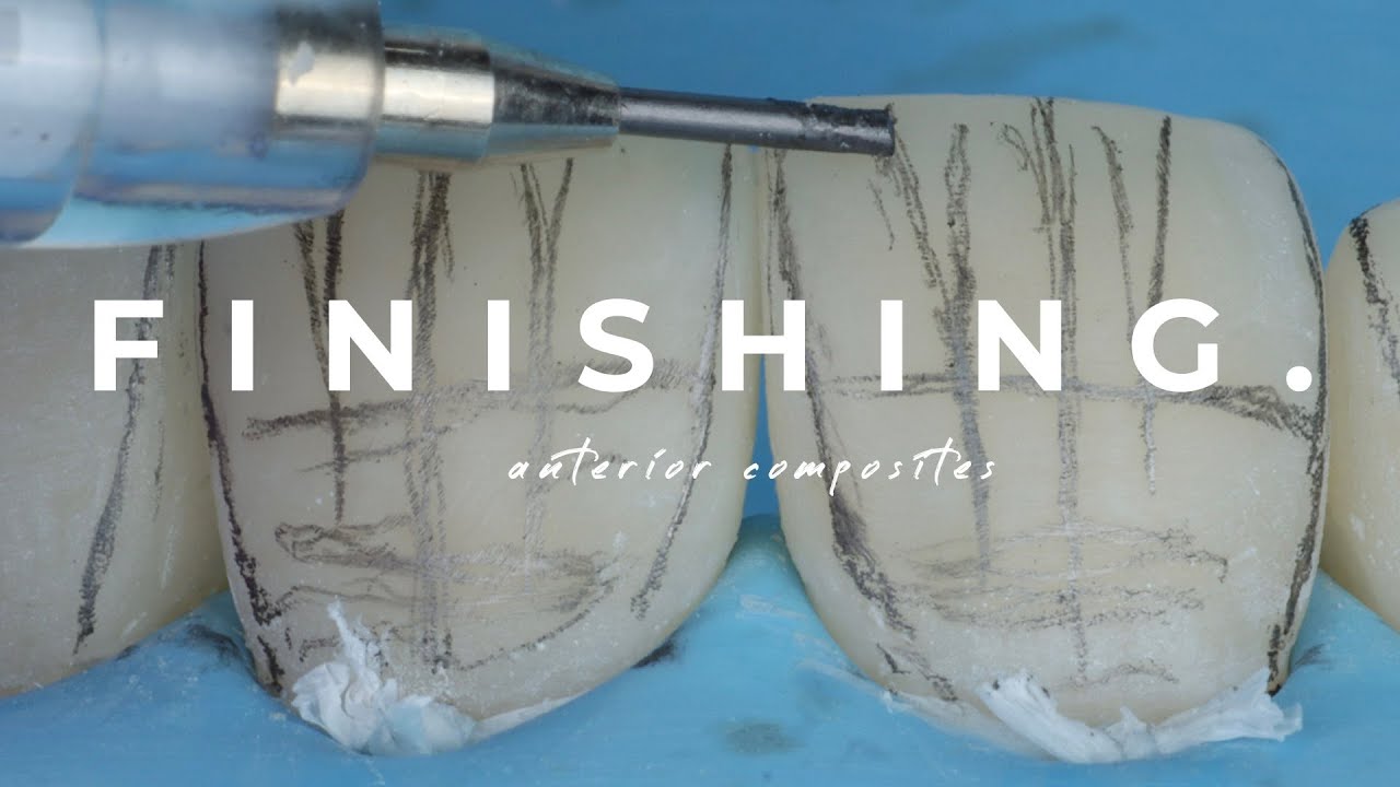 How to finish and polish your anterior composites