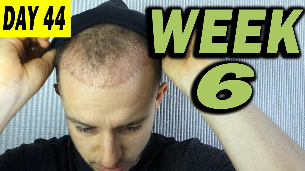 FUE Hair Transplant 6 weeks (post op) Istanbul, Turkey