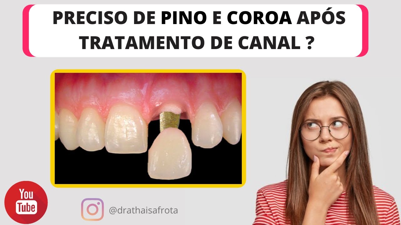 Tratamento de canal, preciso colocar pino e coroa no dente ?