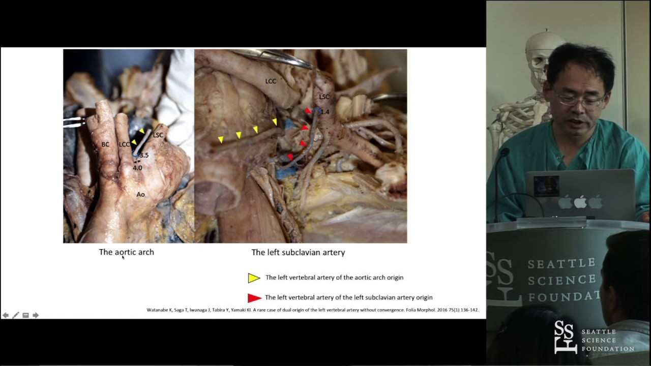 Two Cases of the Duplicated Vertebral Artery - Koichi Watanabe MD, PhD