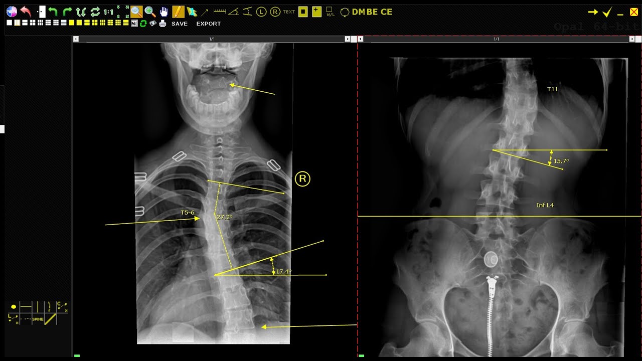 X-Ray Case Study - Let's Talk About Scoliosis!