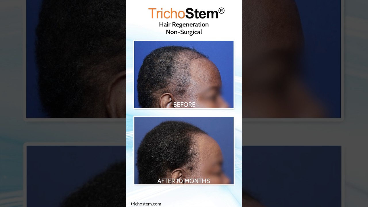 Treating Female Pattern Hair Loss in 1-2 Sessions #femalehairloss