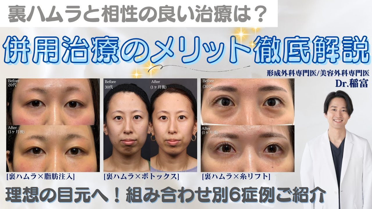 術後の後悔をなくす為に！裏ハムラ×おすすめ併用治療(全6症例)を形成外科専門医が解説【糸リフト/脂肪注入/眉下切開/二重/ボトックス】
