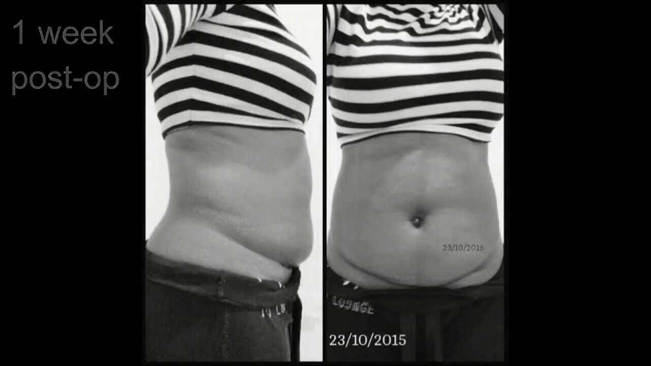 My Open Myomectomy Surgery Before/After
